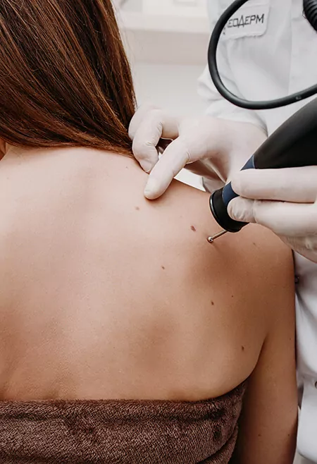 moles and skin treatment