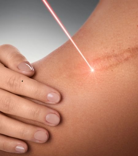 burn scar treatment