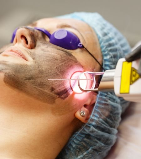 laser toning