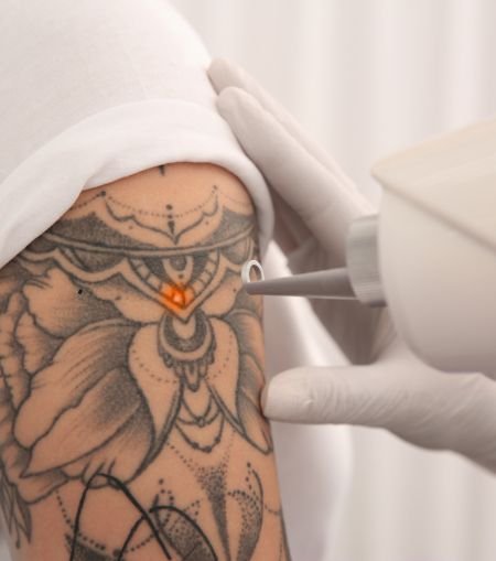 tatoo removal