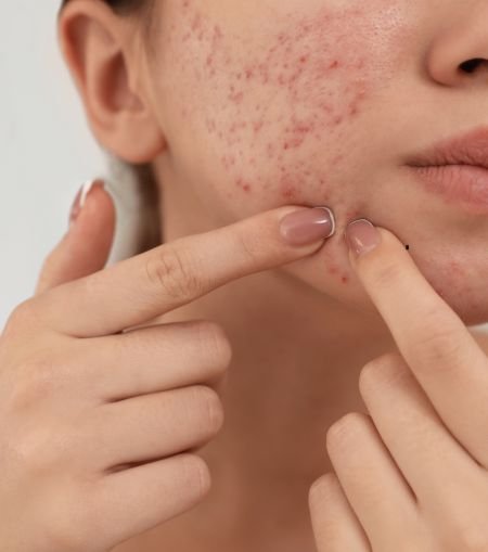 Acne (Pimples) Treatment