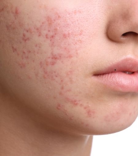 Acne (Pimples)