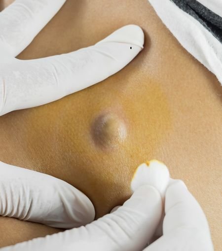 Cyst Excision