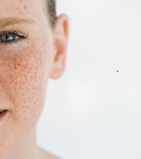 Freckles