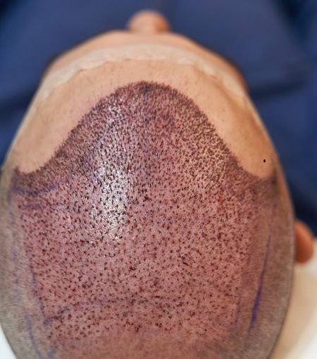 Hair Transplant