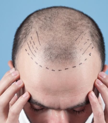 Hair Transplantation