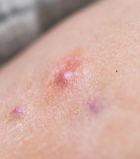 Hidradenitis Suppurativa
