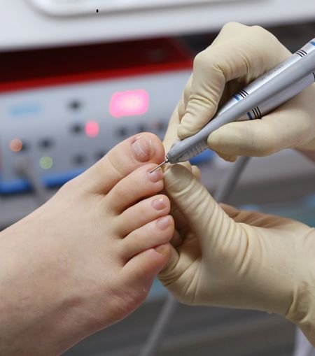 Ingrown Toenail Surgery