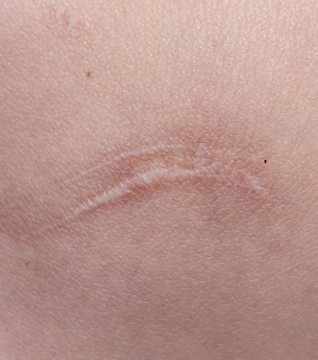 Keloid Scars