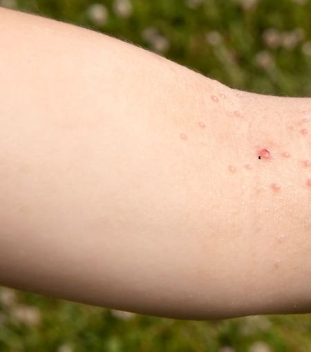 Molluscum Contagiosum