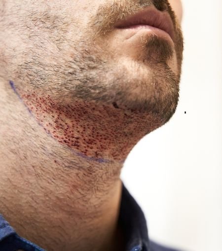 Moustache & Beard Transplant