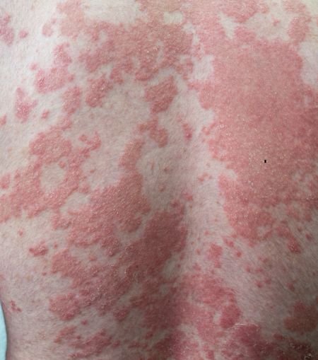 Psoriasis