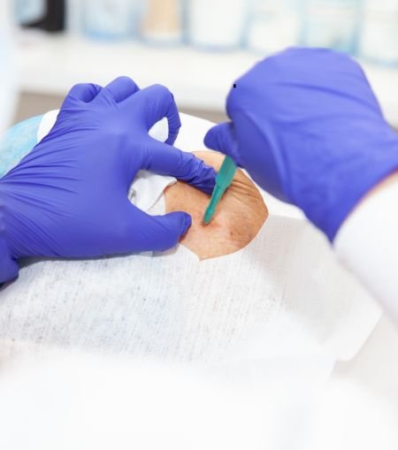 Skin Biopsy