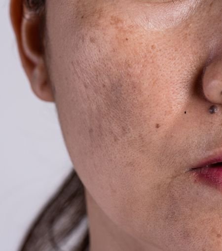 Skin Pigmentation & Melasma