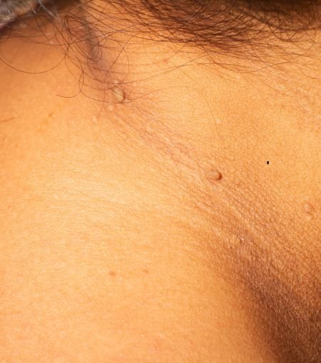 Skin Tag Removal