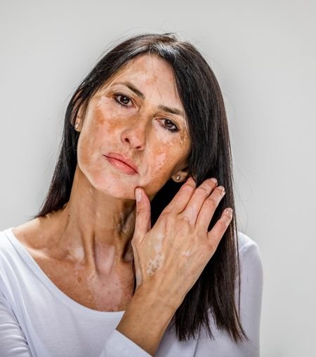 Vitiligo Surgery