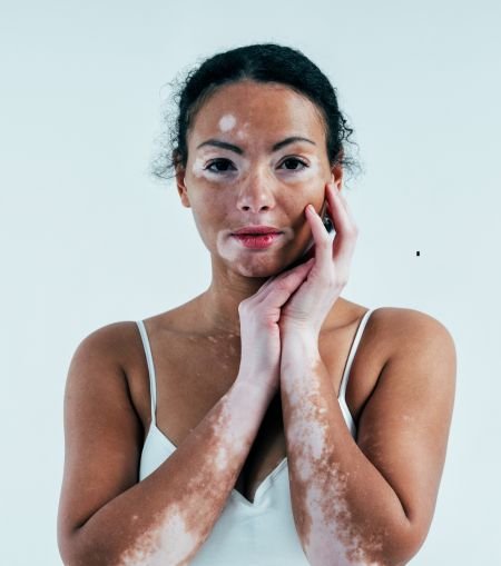 Vitiligo