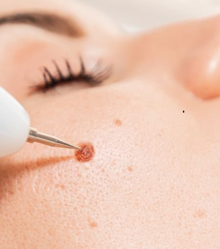 Warts Removal
