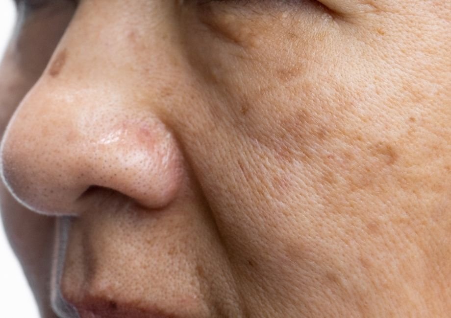 Melasma & Pigmentation