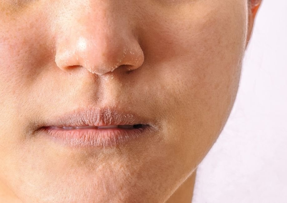 skin dryness in winter solution